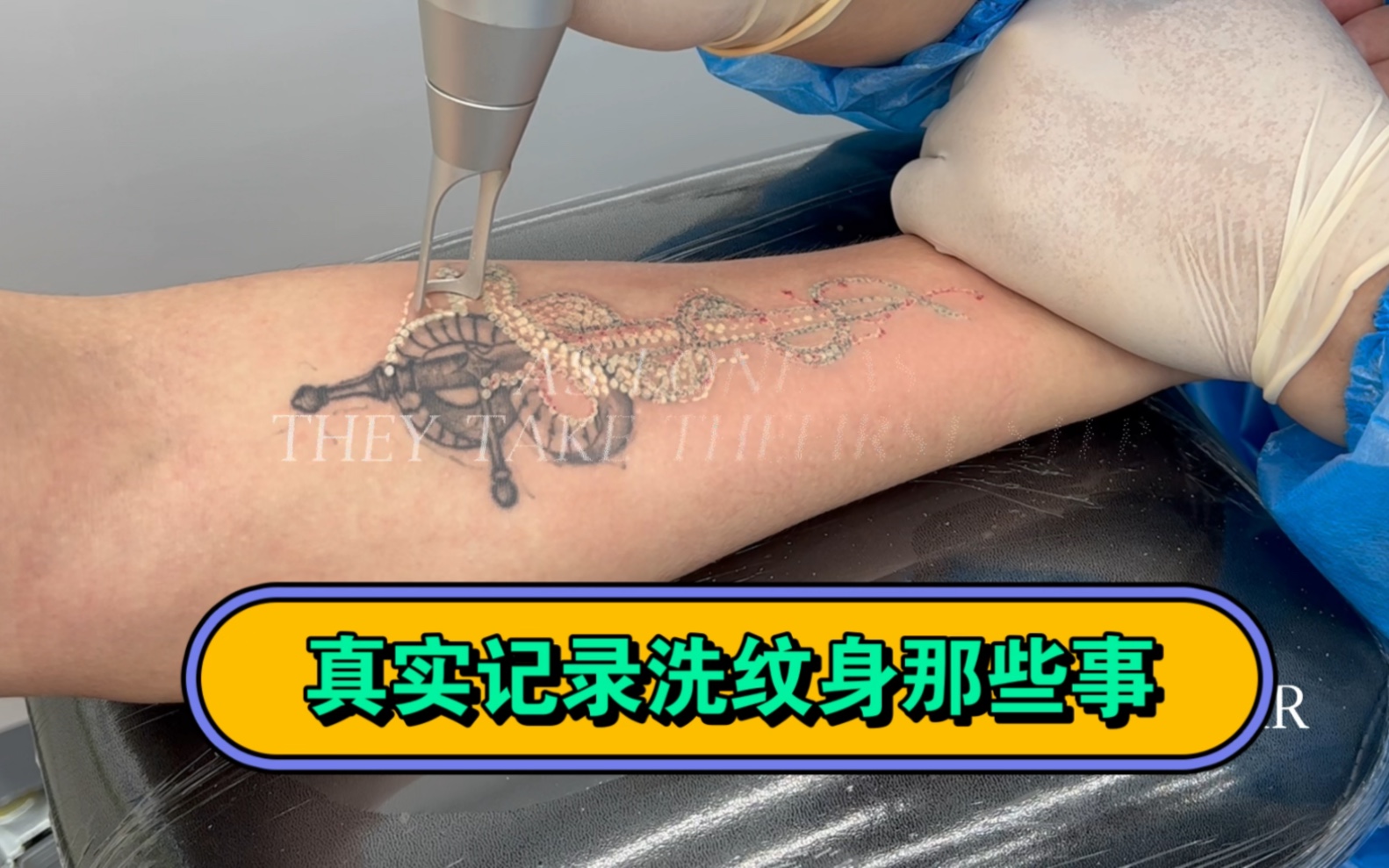 真实拍摄记录洗纹身那些事 ,帮你了解洗纹身