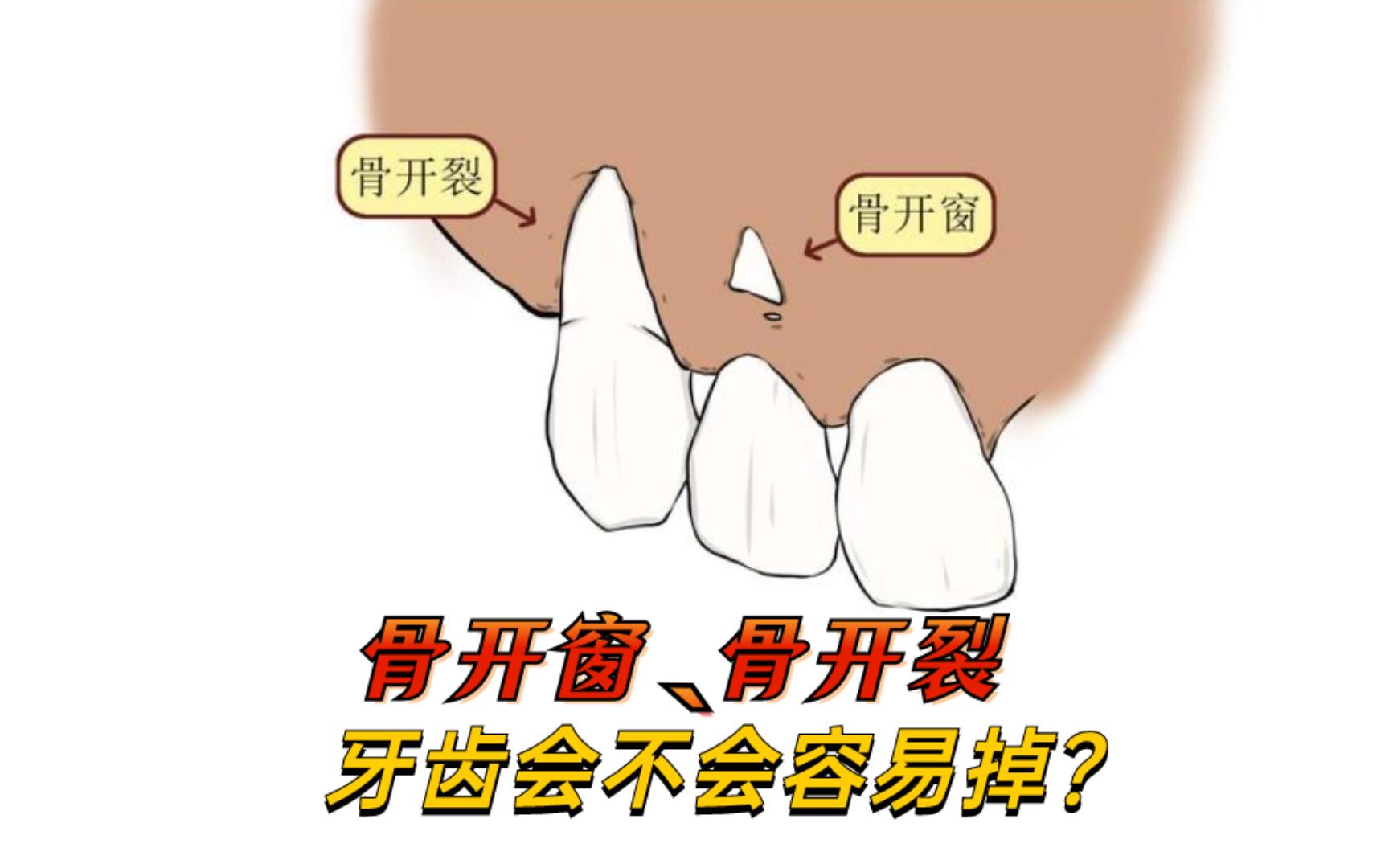 骨开窗,骨开裂牙齿会不会容易掉?