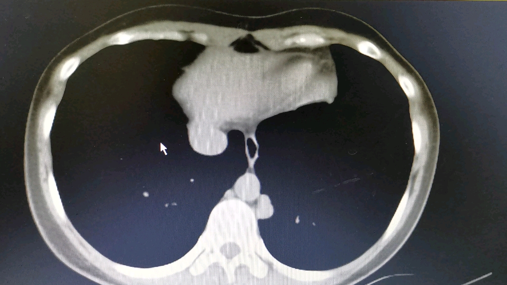 胸膜下的同样边缘清晰的结节会是什么呢?