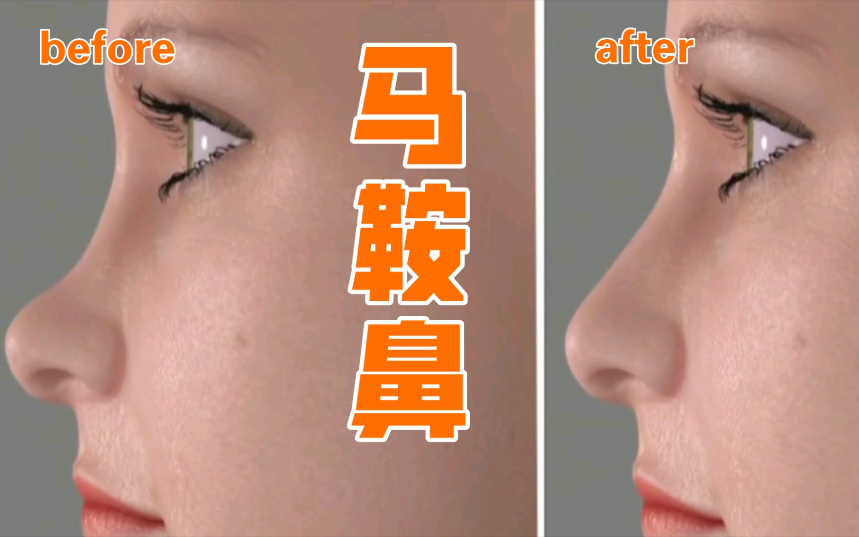 20秒带你了解隆鼻怎么隆马鞍鼻怎么垫高