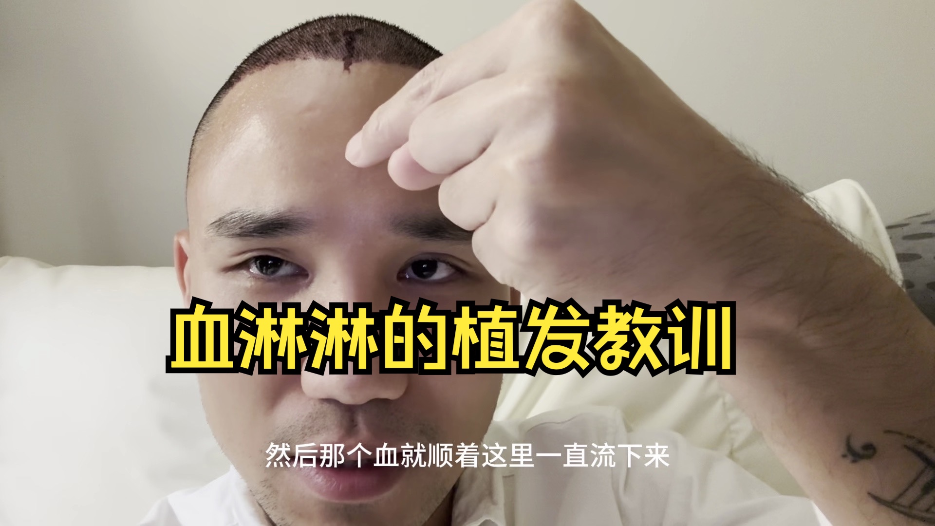 瓜州植发(兰州植发多少钱)