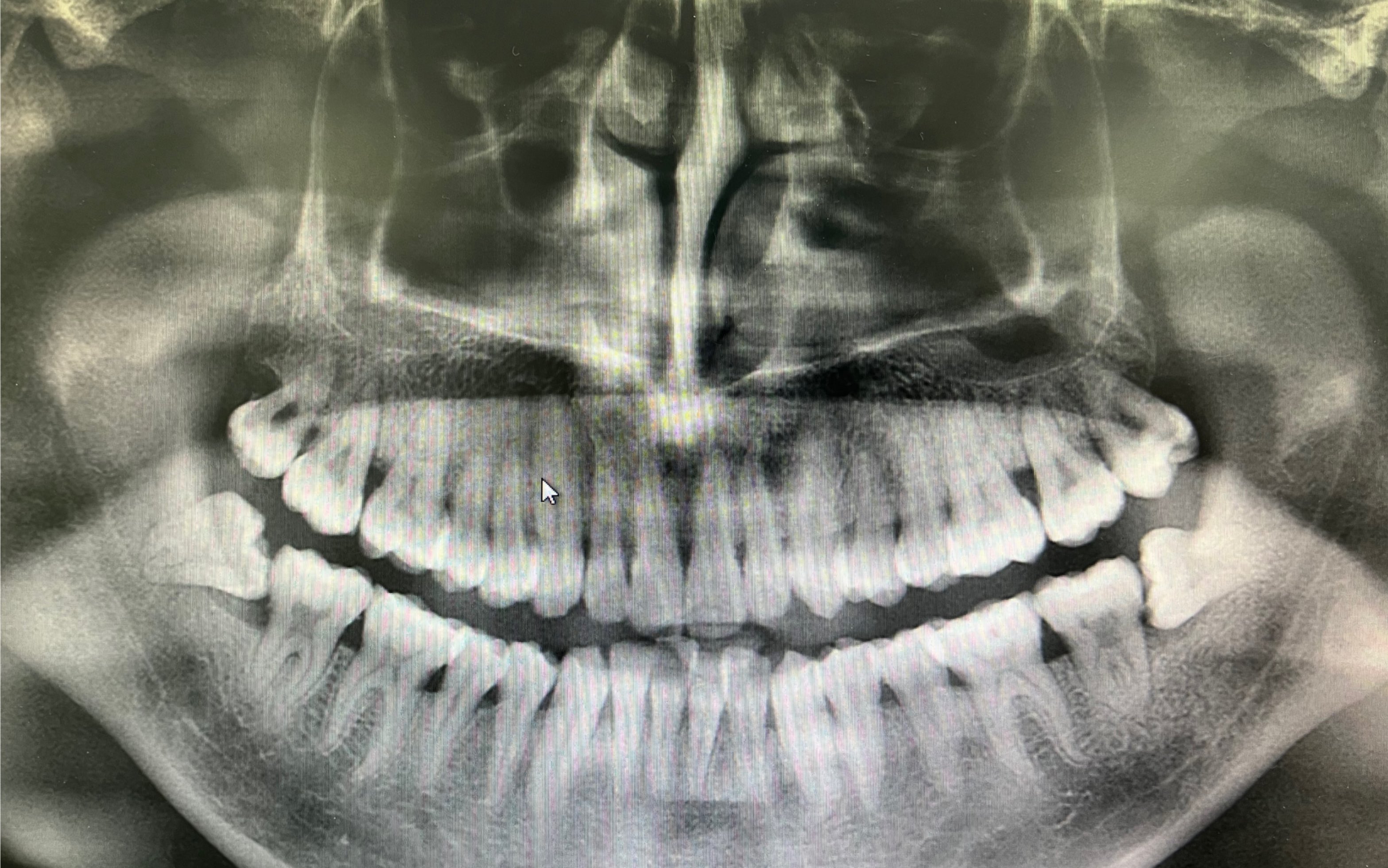 拔除上颌及下颌近中阻生智齿,用时6分钟.