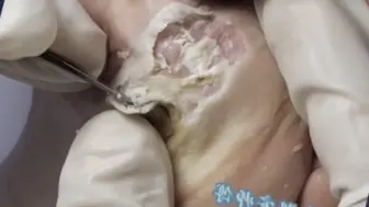 Descargar video: 超级解压系列    好吓人这个脚太多鸡眼