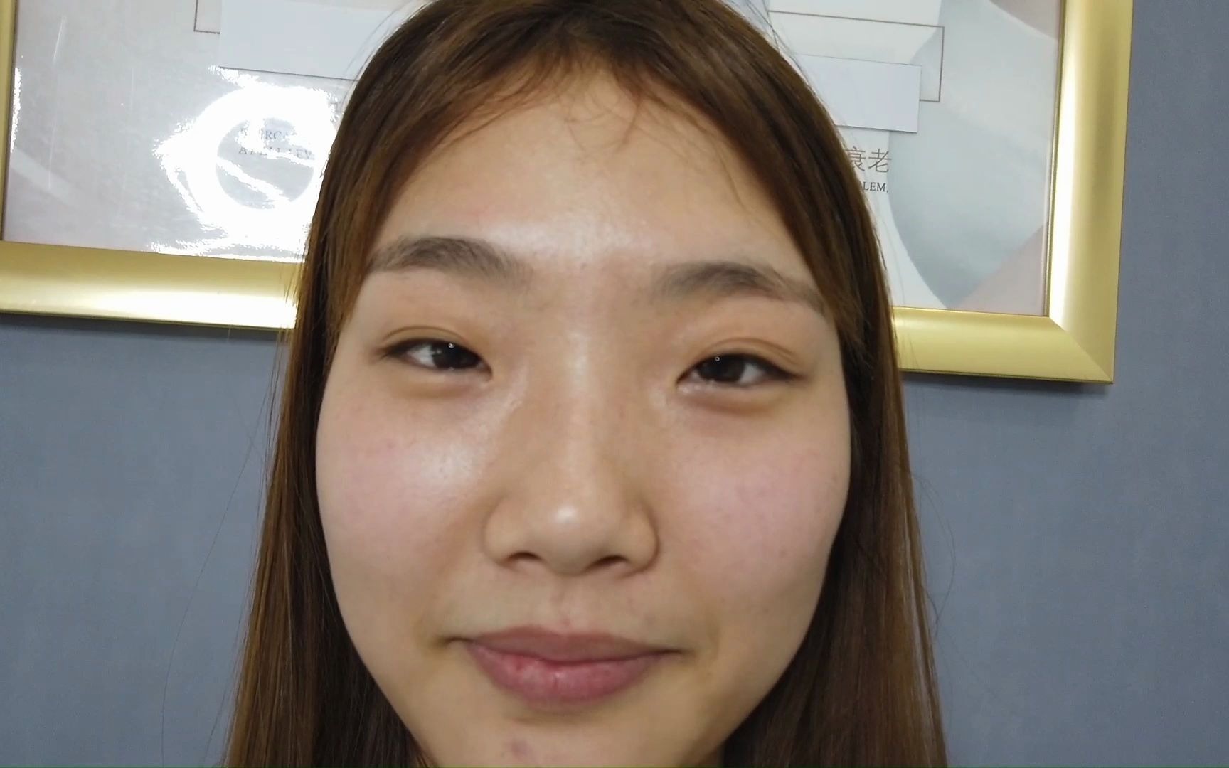 内眦间距宽双眼皮多层 围绕往自然协调方向设计 术后即刻对比状态