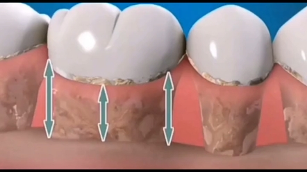 龈下刮治是去除位于牙周袋内根面上的牙石和菌斑.龈下刮治术主要用于牙周炎,牙龈炎等.#龈下刮治术 #牙结石 #雅美佳口腔连锁哔哩哔哩bilibili