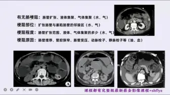 Video herunterladen: 腹部CT训练营-攻克急腹症共33讲03：肠梗阻CT阅片要点-消化道梗阻CT诊断要点直析-连世东