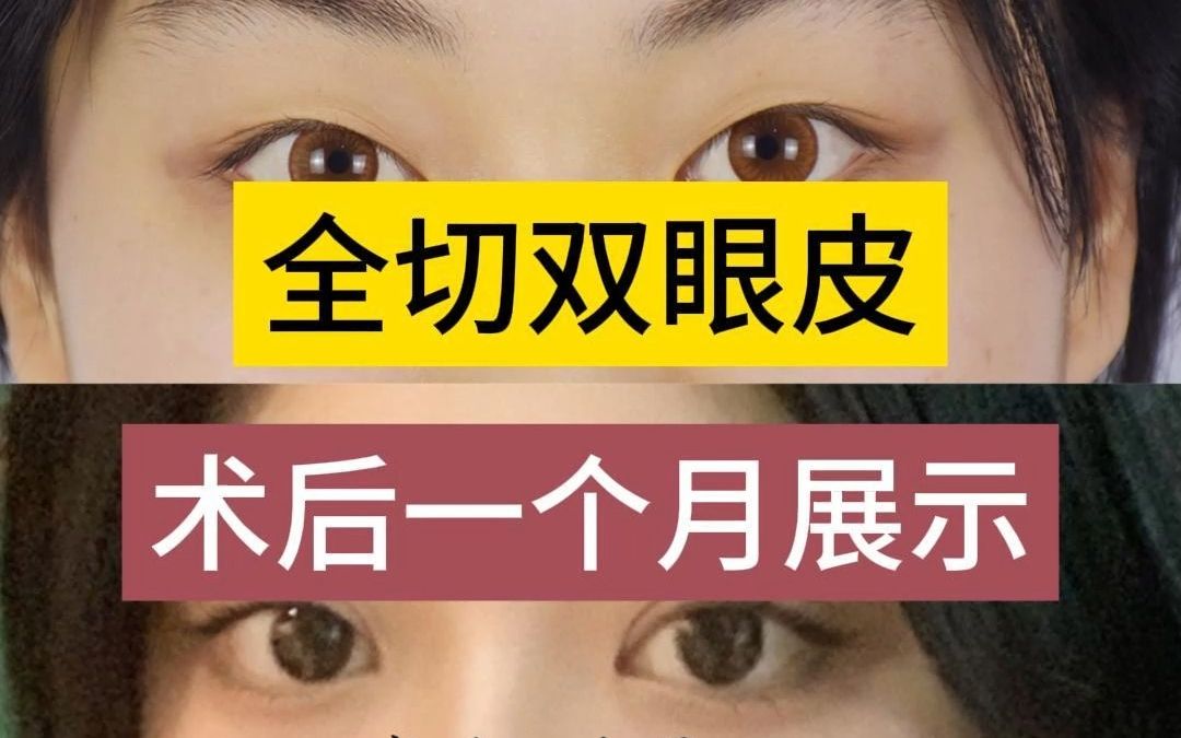 全切双眼皮术后一个月展示