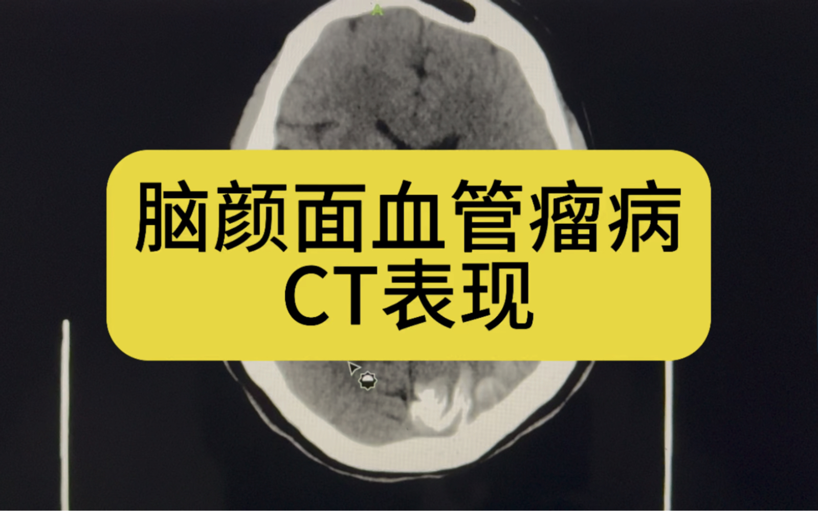 脑颜面血管瘤ct典型表现