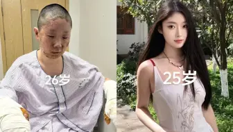 27岁美妆博主一家三口因液化气泄漏烧伤，当事人：瞬间闪爆震感很强，父母当晚进ICU