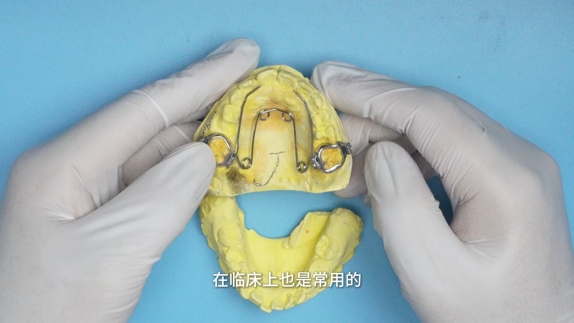 四眼簧扩弓器 妃她正畸 儿童牙齿矫正器 活动矫正器