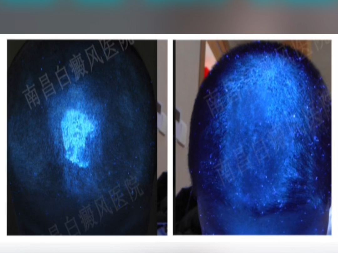 日常生活中看见的头上的白癜风