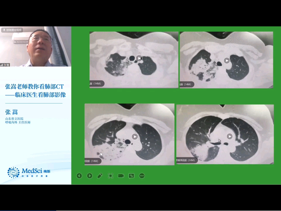 [图]张嵩老师肺实变影像