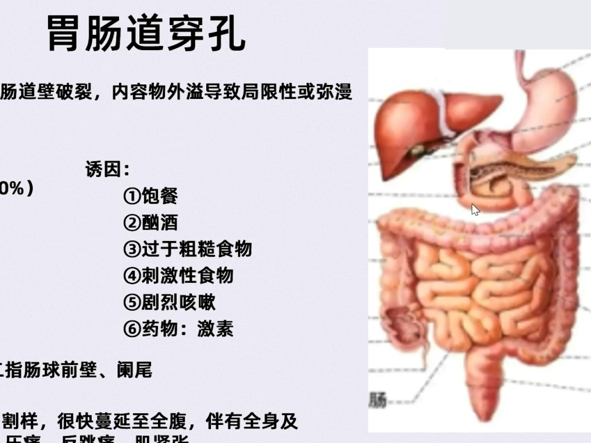 腹部CT训练营:攻克急腹症(共38讲)06消化道穿孔(上):CT解读要点哔哩哔哩bilibili