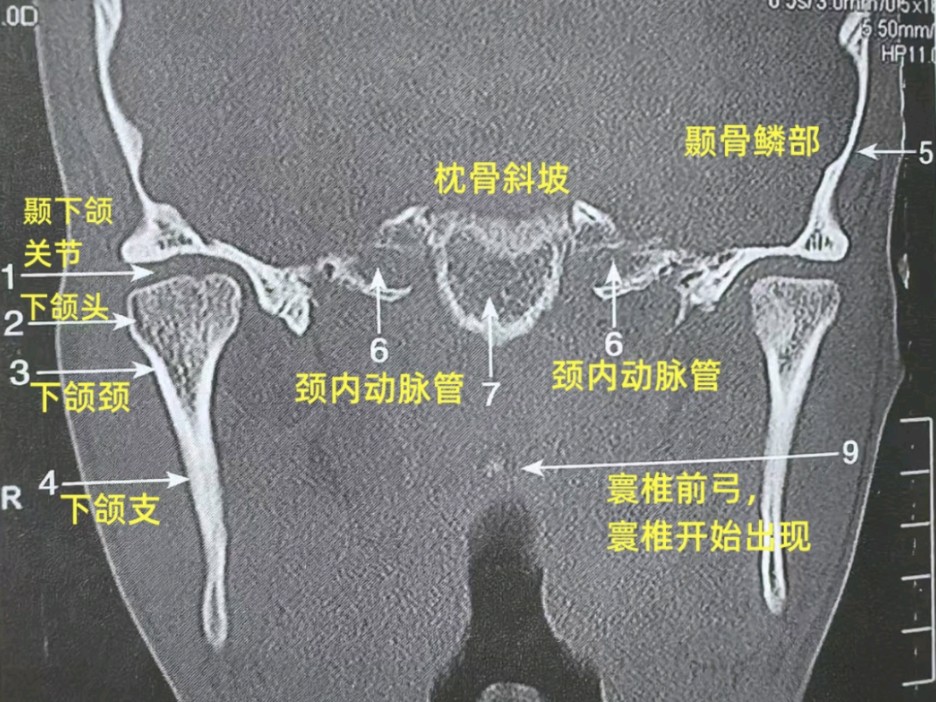 枕骨斜坡位置图片