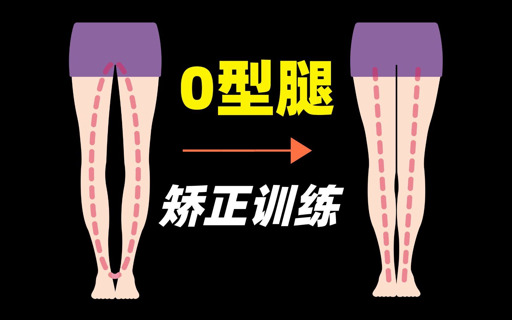 O型腿矫正训练!7个动作,有效矫正O型腿和膝超伸哔哩哔哩bilibili