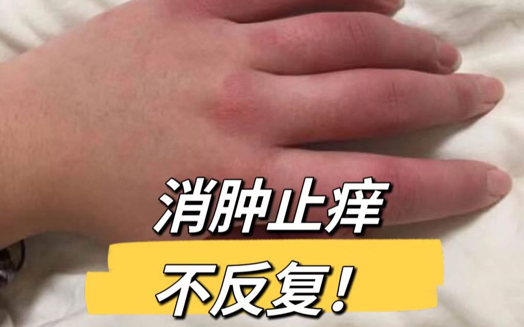 [图]冻伤反复发作又疼又痒！有没有根治的方法？过来人经验无偿分享！