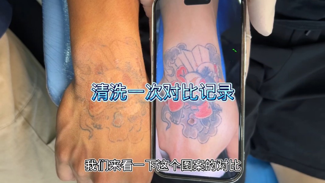 b站过来的粉丝,手背彩色纹身清洗一次对比记录,准备清洗第2次