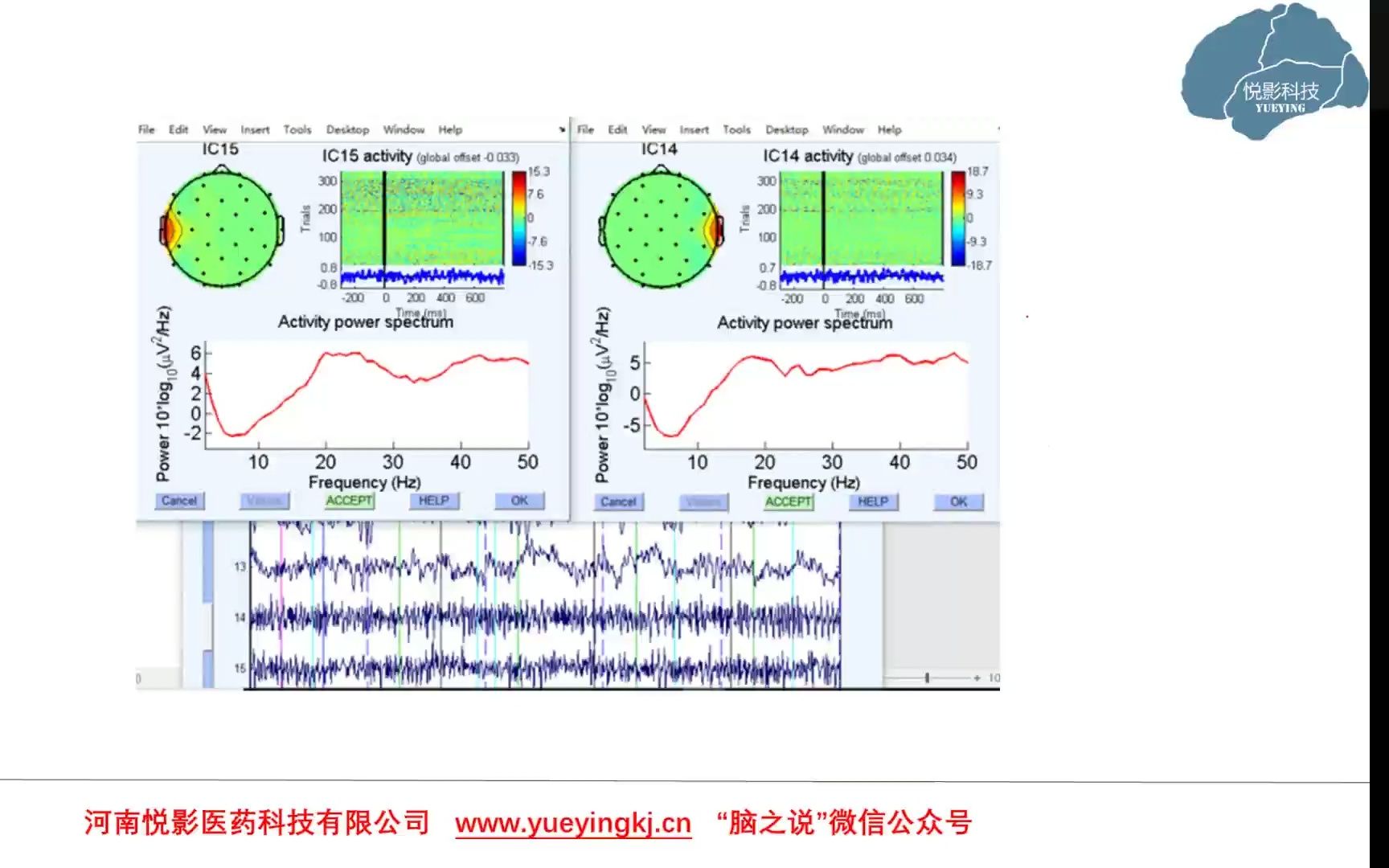 EEG\ERP基础知识系列讲座第45讲:脑电中的肌电伪迹及ICA鉴别哔哩哔哩bilibili