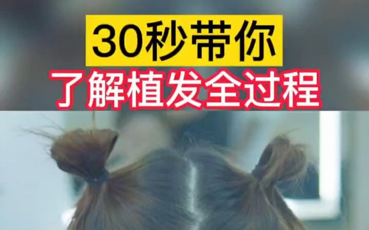 【老宋科普】30秒带你看完植发全过程!哔哩哔哩bilibili