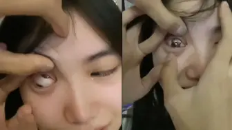 Скачать видео: 谨慎观看！女子哭泣致美瞳滑落眼皮里，好不容易转眼球将它取出