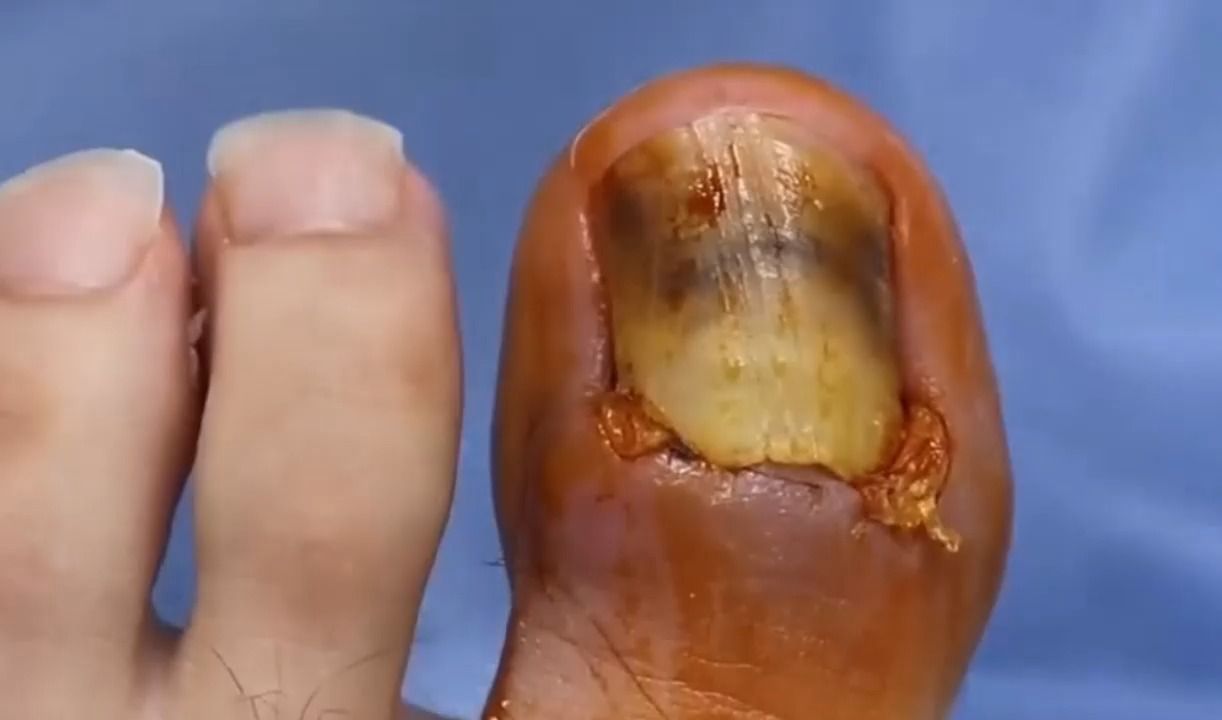 甲沟炎,趾甲废了,直接拔掉 !