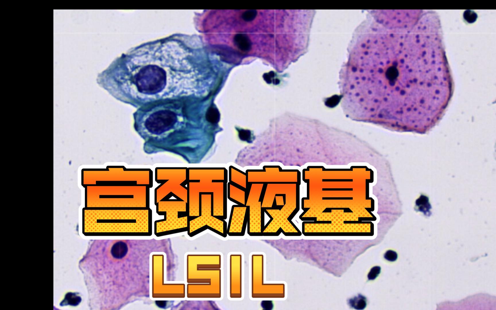 【病理61】宫颈液基细胞学诊断LSIL哔哩哔哩bilibili