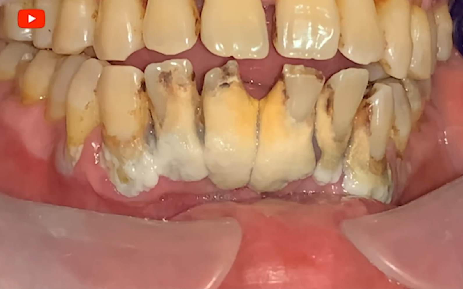 这门牙全靠牙结石撑着了!