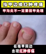 Download Video: 指甲边缘红肿疼痛，甲沟炎不一定要拔甲处理