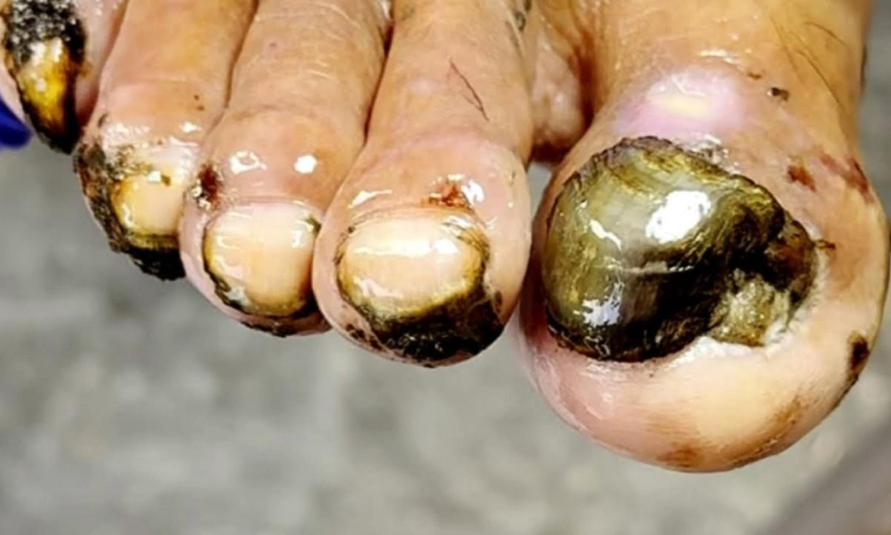 开饭了开饭了,见过如此恶心的脚趾甲吗?