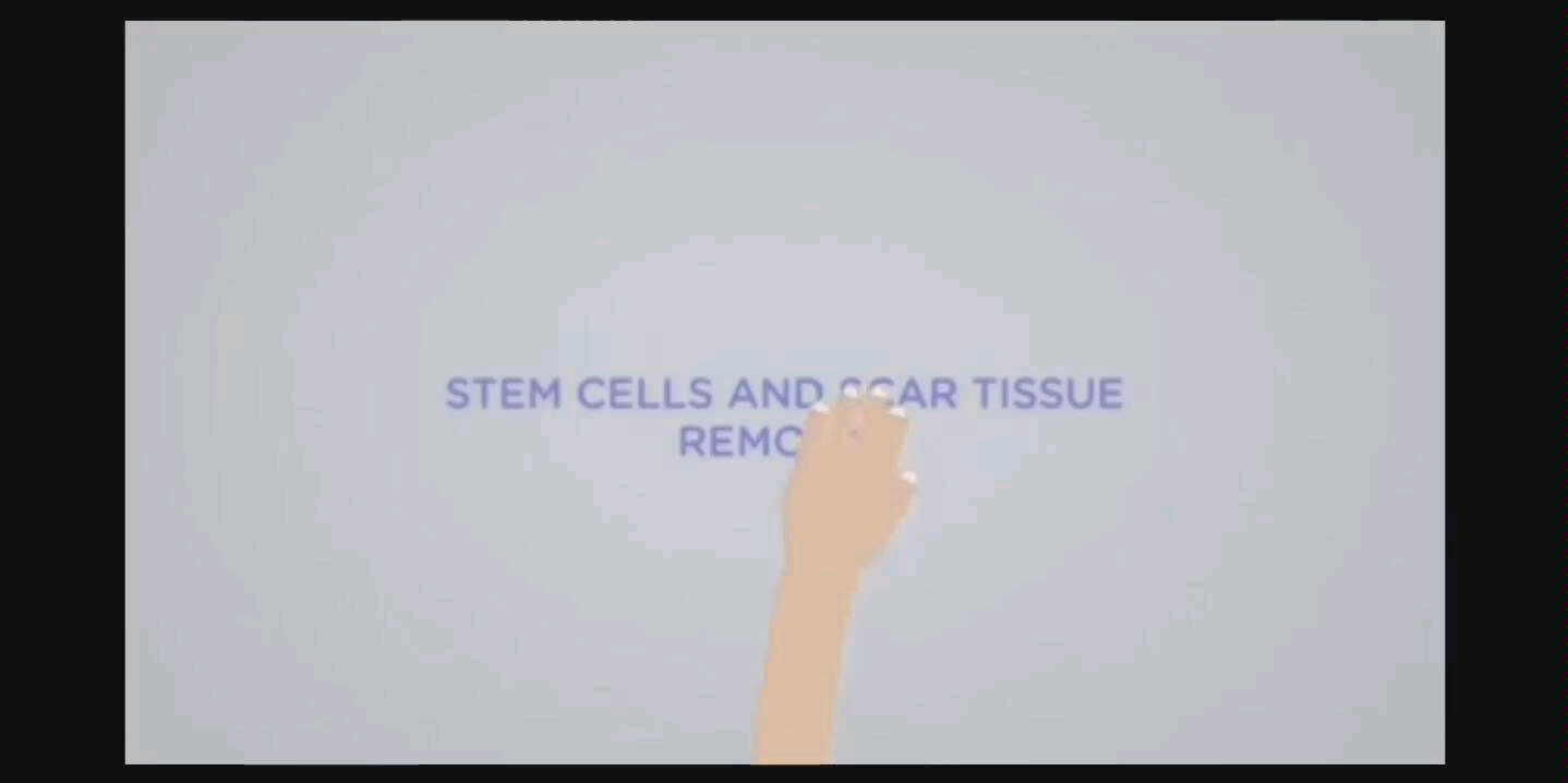 [图]感受振动NO.13 “Stem Cells and Scar Tissue Removal”