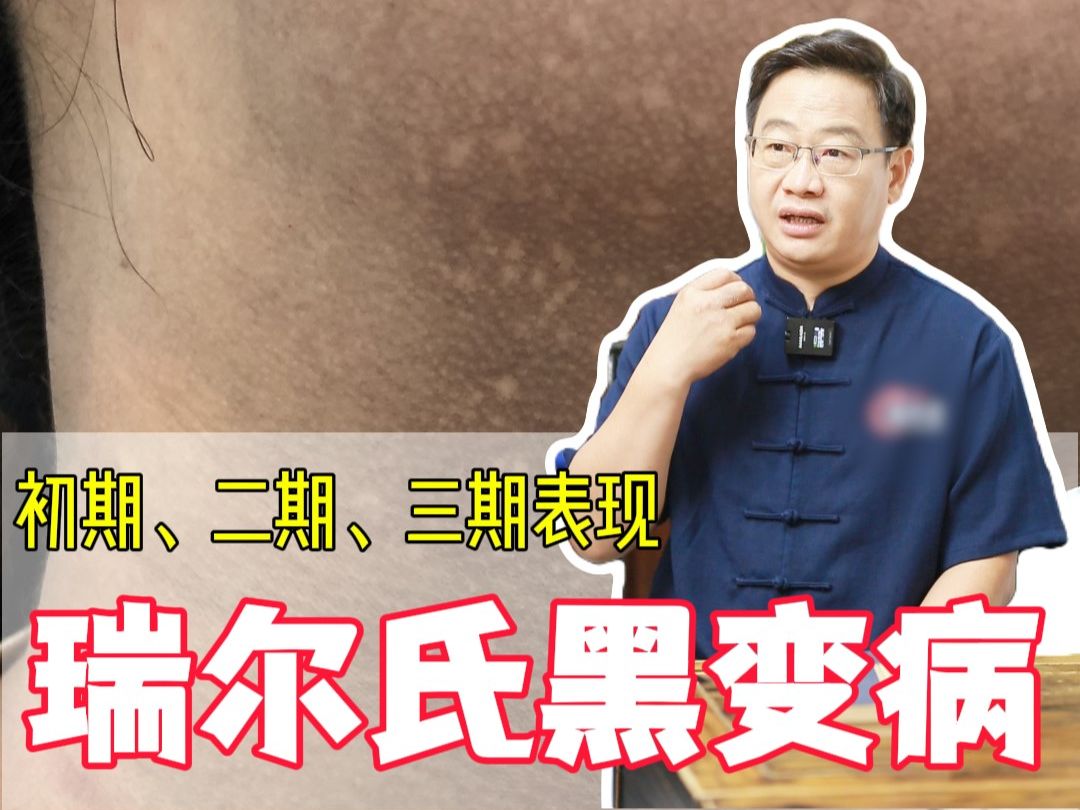 瑞尔氏黑变病,三期表现分别是?哔哩哔哩bilibili