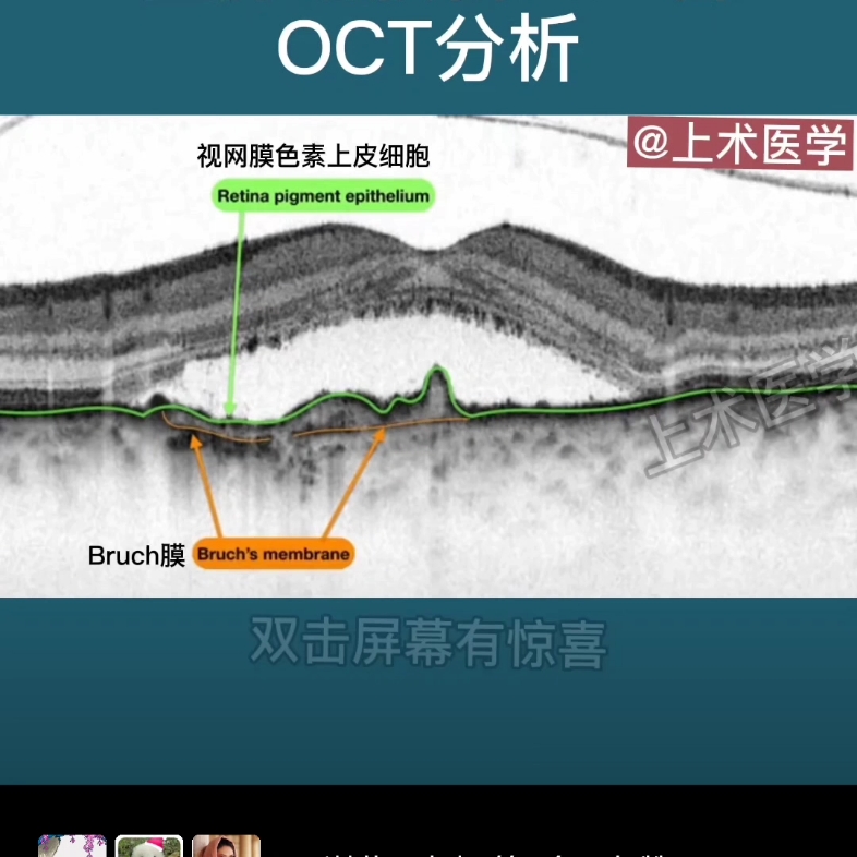 [图]黄斑水肿 oct