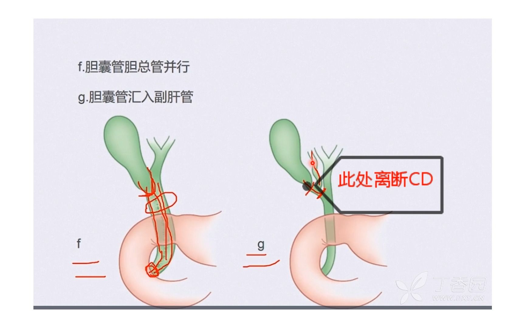 胆囊、胆管解剖变异哔哩哔哩bilibili