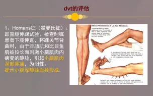 Download Video: DVT的预防及护理PPT