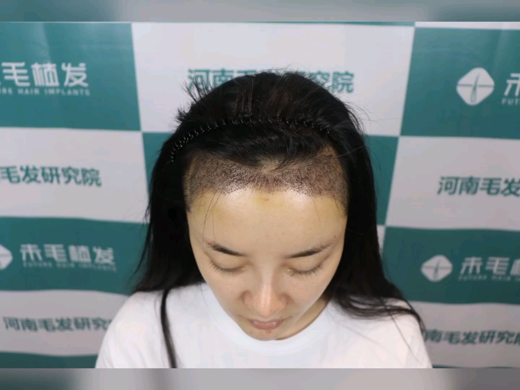 发际线种植：重塑自信的新选择