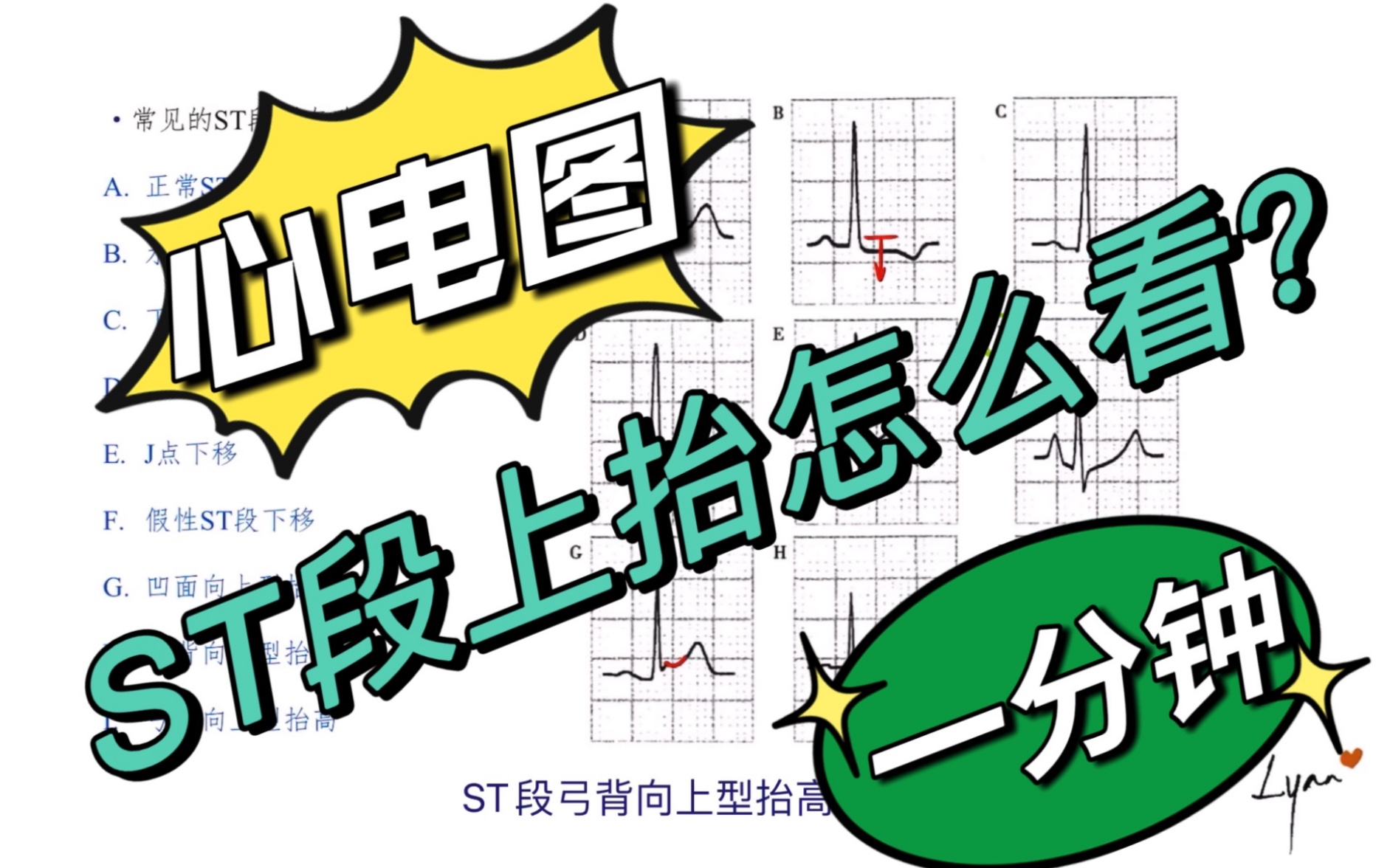 [原创] 到底什么是ST段抬高啊?一分钟搞明白!哔哩哔哩bilibili