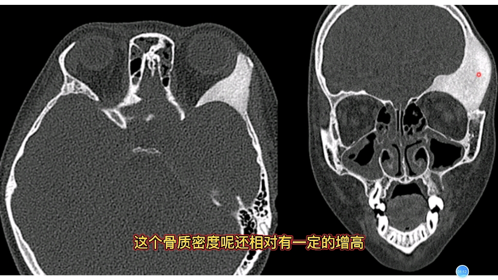 骨纤维异常增殖症典型ct病例分享,简单易懂,实用干货!