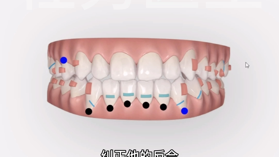 视频解析,隐适美牙套如何纠正牙齿地包天?哔哩哔哩bilibili