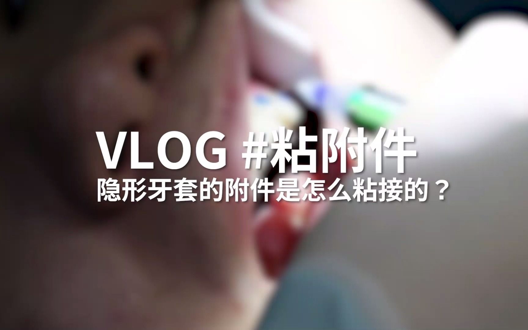 【隐形牙套vlog】隐形牙套只要戴上就可以了吗?不!医生还要给你粘附件哔哩哔哩bilibili