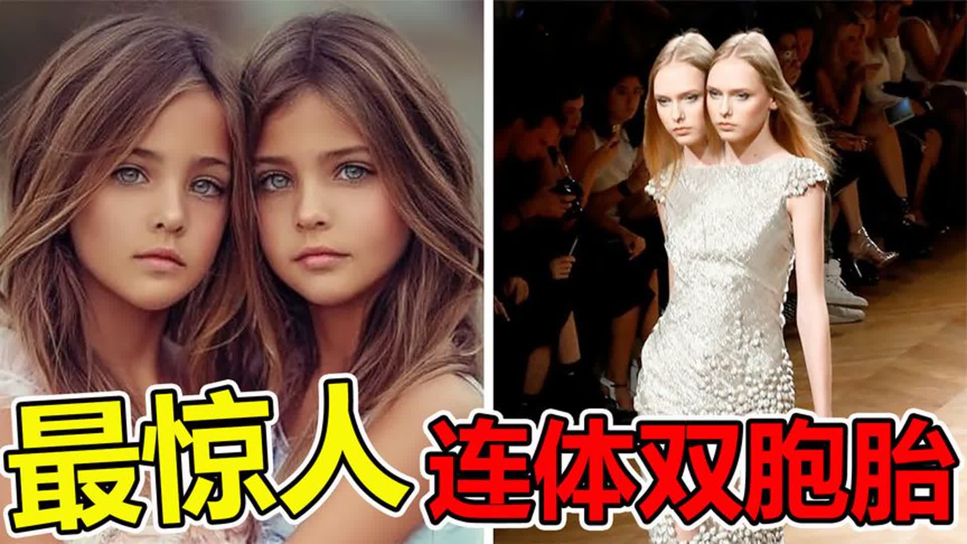 世界上“最罕见”的10对,连体双胞胎哔哩哔哩bilibili