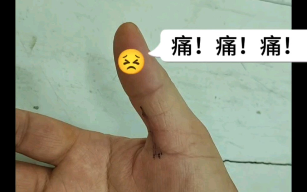 右手拇长屈肌缩窄性腱鞘炎,局部封闭治疗.哔哩哔哩bilibili