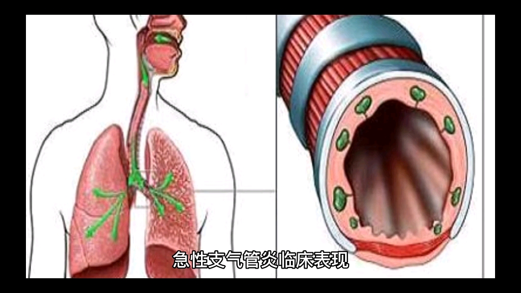 急性支气管炎临床表现哔哩哔哩bilibili