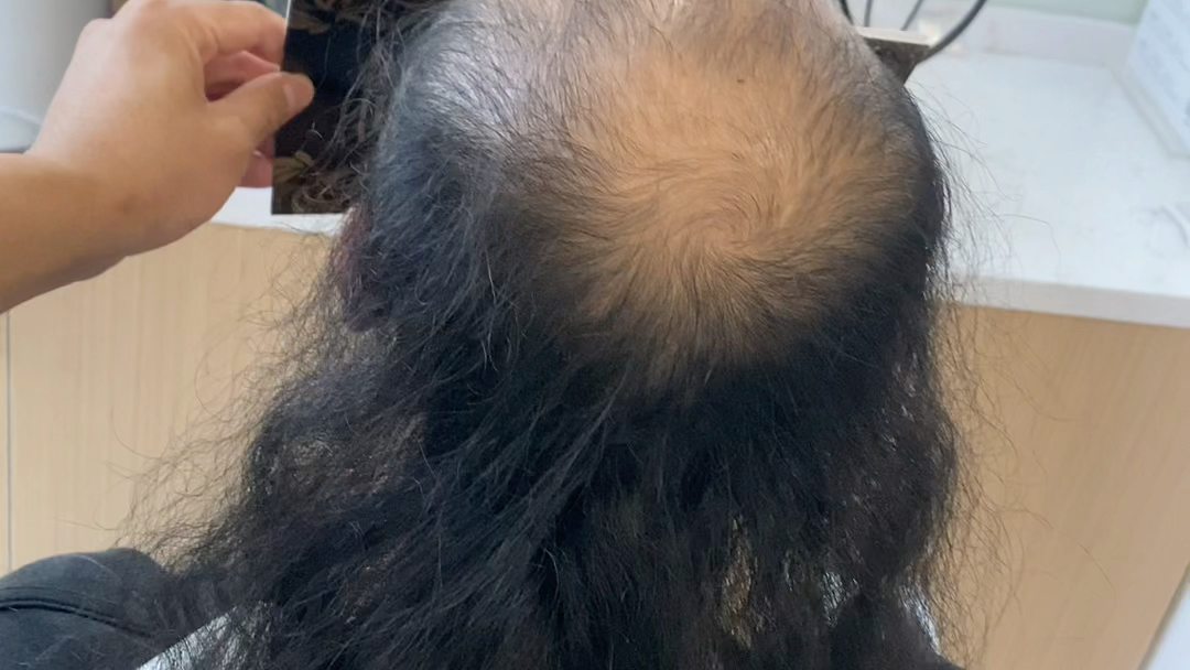 兄弟植发(植发成功案例视频)