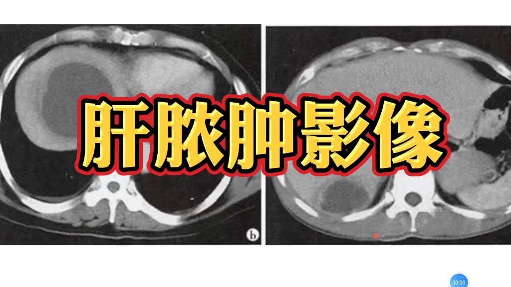 典型肝脓肿CT影像表现分享,2分钟学会自己看!哔哩哔哩bilibili