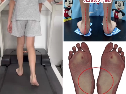 11岁女生重度扁平足疼痛,足外翻,步态异常.