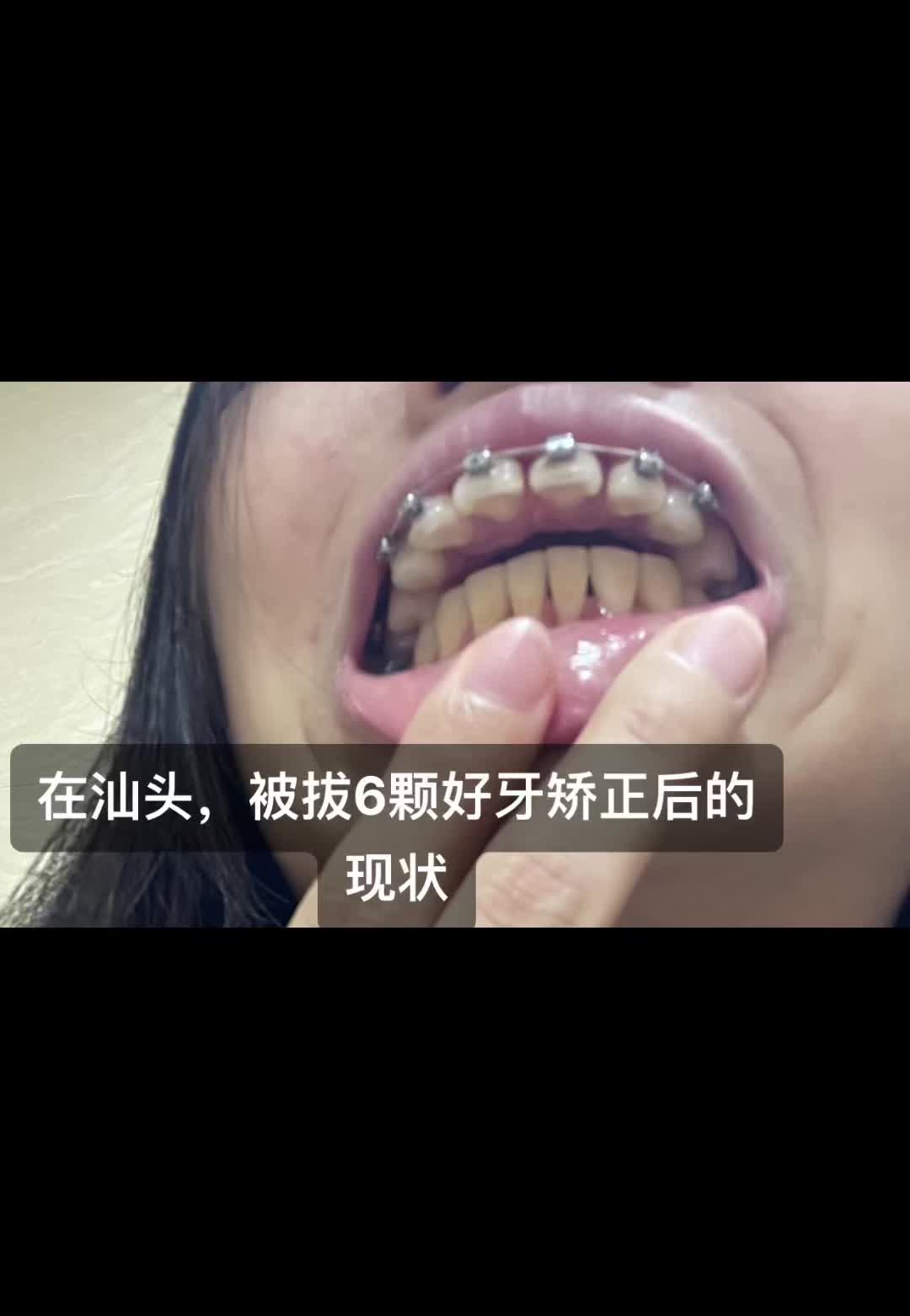 为什么汕头市润康口腔毁了我的健康,还可以不负责任的继续谋财害命,而我没有错却要一辈子活在病痛之中!哔哩哔哩bilibili