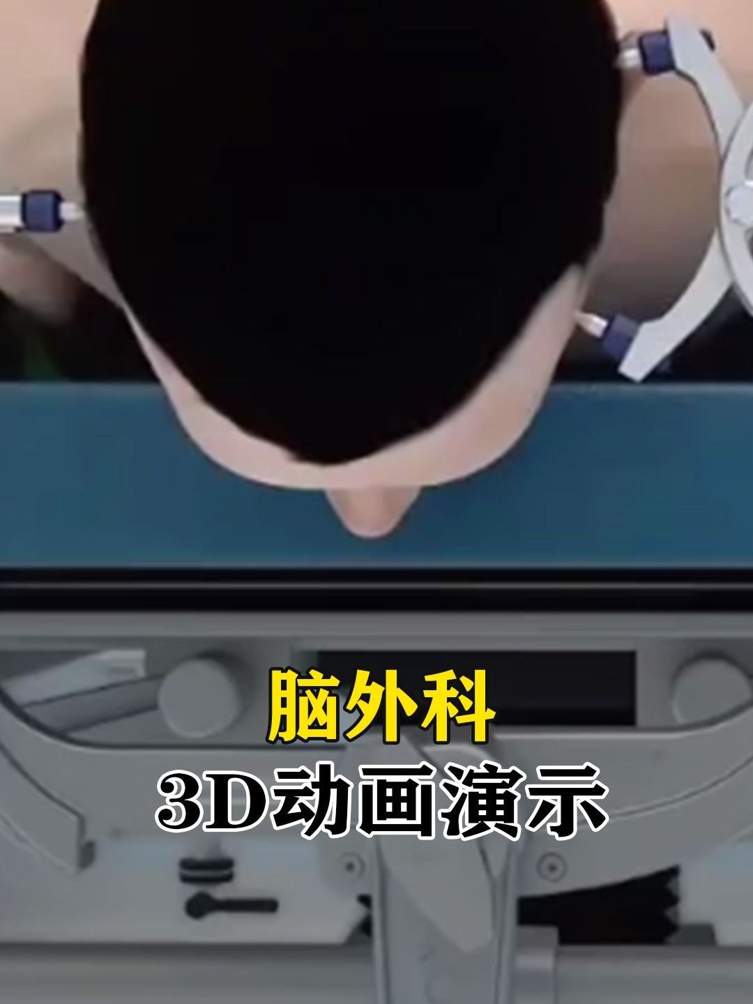 脑外科,3D动画演示哔哩哔哩bilibili