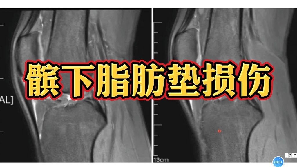 髌下脂肪垫损伤MRI表现分享,放射科医生讲解!哔哩哔哩bilibili