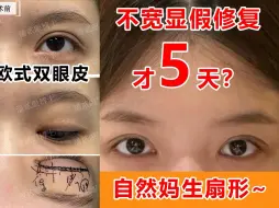 Download Video: 真假？全切平行9mm双眼皮，不宽却假眼修复才5天竟恢复这等自然？