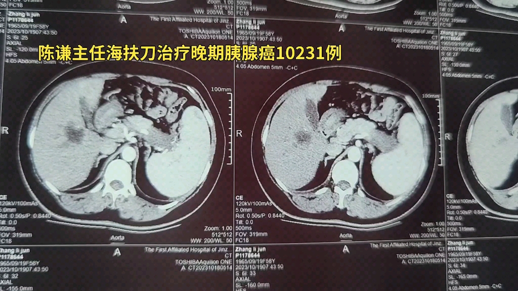 陈谦主任海扶刀治疗晚期胰腺癌10231例哔哩哔哩bilibili